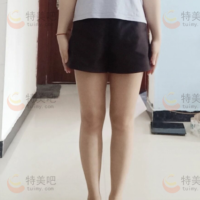 北京禾美嘉医疗美容诊所吸脂瘦大腿术后两个月，大腿瘦到47